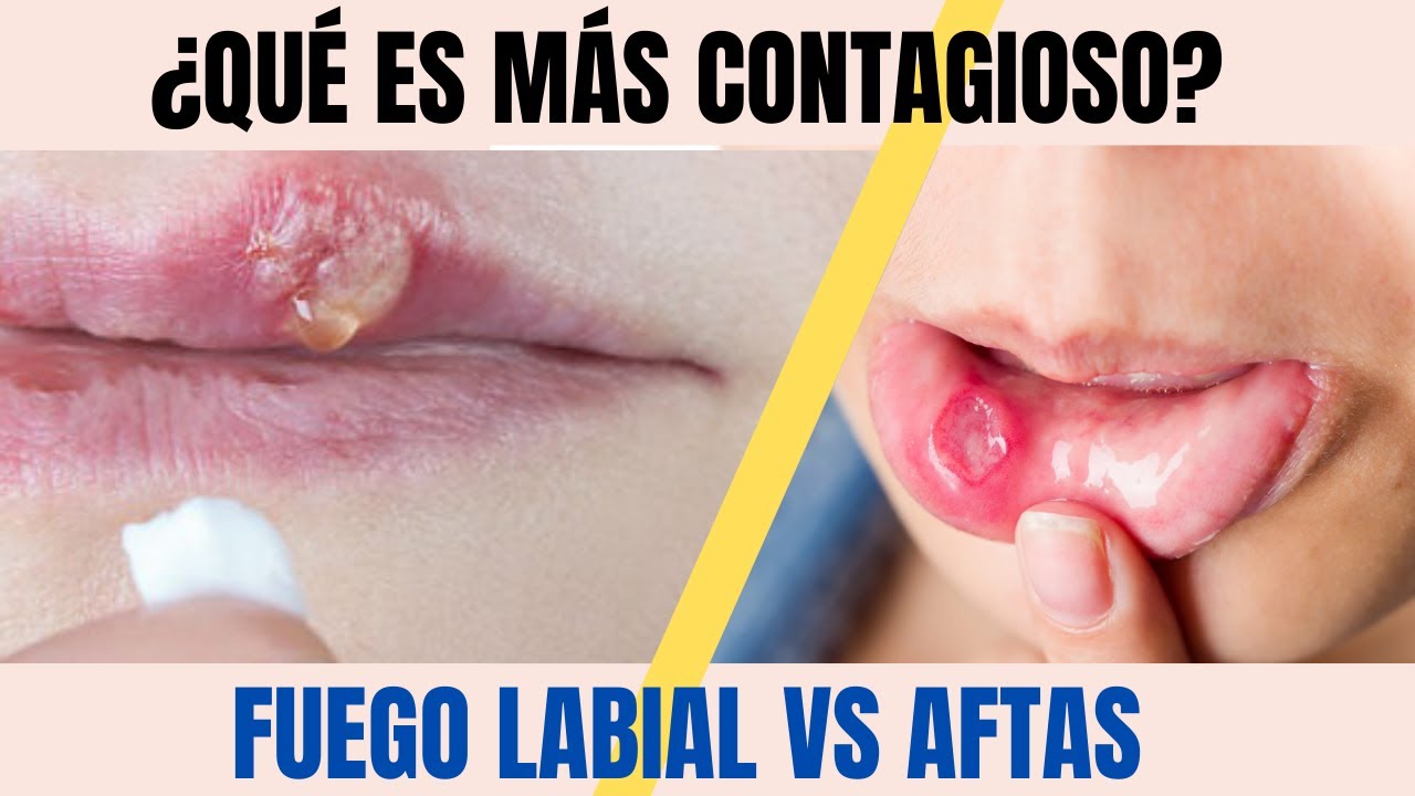porque salen ampollas en la boca y como curarlas